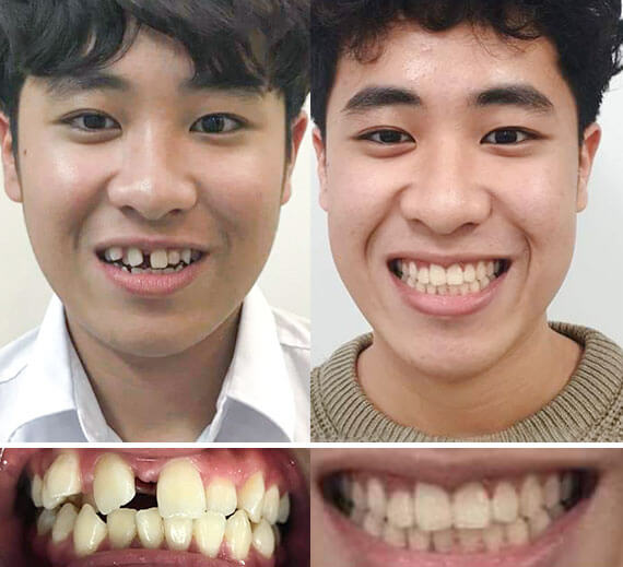 KH NGUYỄN BẢO MINH (RĂNG THƯA)Kết quả sau 12 tháng niềng răng