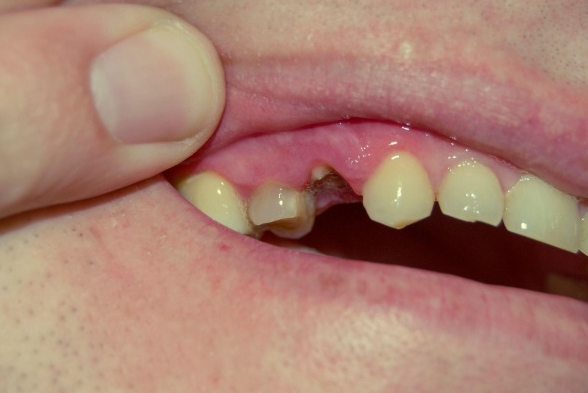 nhổ răng số 4