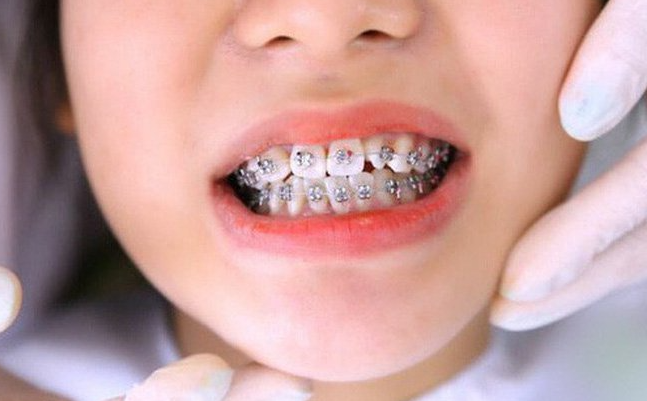 kinh nghiệm niềng răng cho trẻ