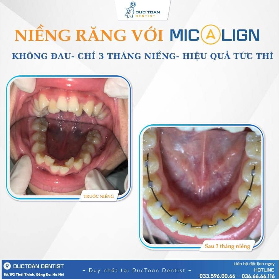 nieng-rang-micalign